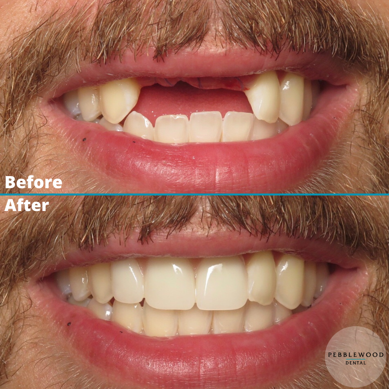 Man patient with dental veneers by Pebblewood Dental