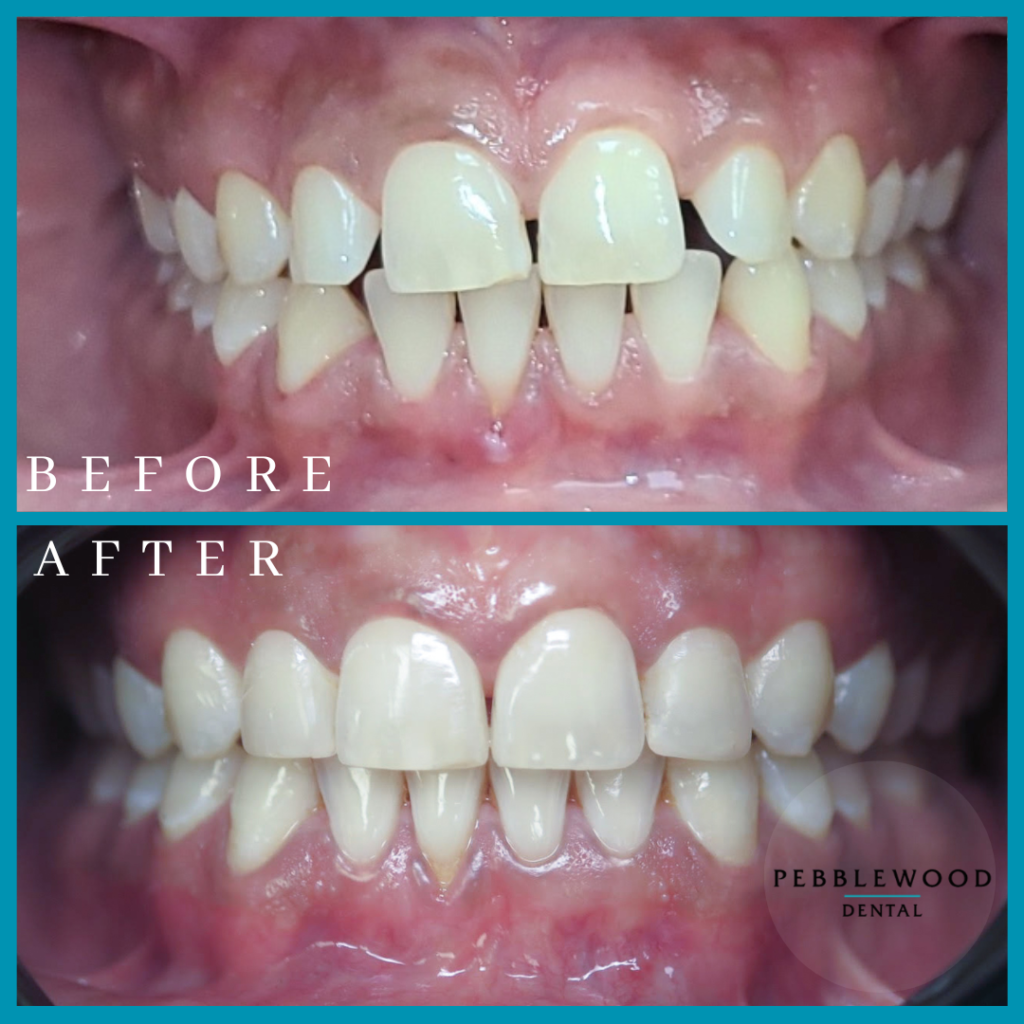 Patient before and after teeth correction